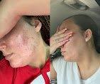 Loving these acne boot camp results! Acne treatments are available. Book your consultation here in Hamilton,NJ.