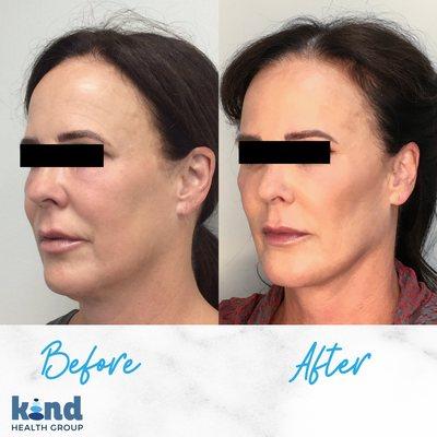 Before and after cheek and jawline filler using the Y-Lift technique by Dr. Georgine Nanos.