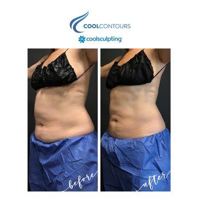 Get sculpted abs and real results at Cool Contours!