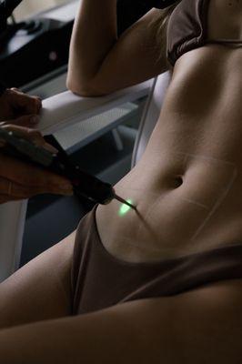 Laser hair removal safe and effective for all skin types on any body areas.