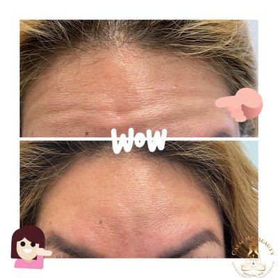 Look at this amazing result from Botox! Beautiful skin requires a commitment, not a miracle!!