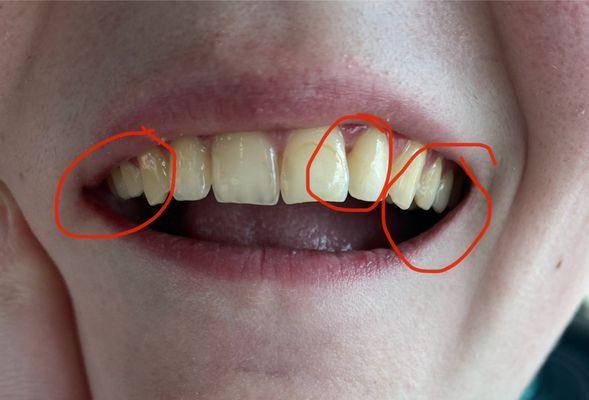 Front view showing recession of right bicuspids compared to left and created hole in incisors.