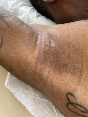 Fresh underarm sugaring