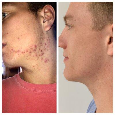 Before and Post Acne Series Treatments.