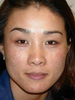 Enhanced Skin Rejuvenation Before