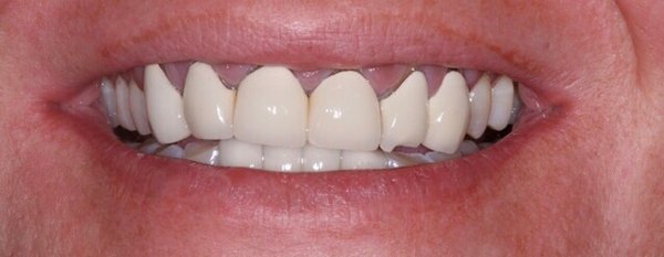 General Dentist's Crowns