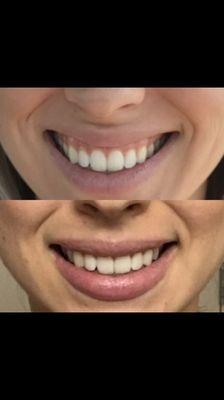 Before and after Botox to correct a gummy smile