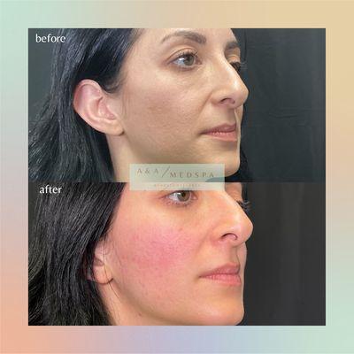 Before and after Versa Filler in Cheeks and dysport neurotoxin in upper face