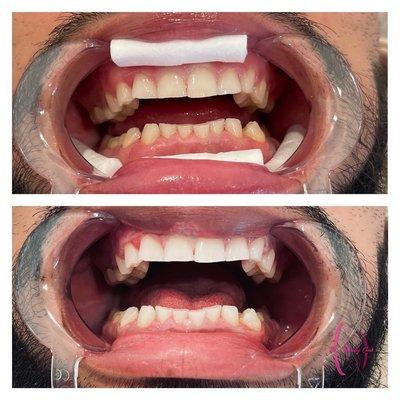 Cosmetic teeth whitening treatments