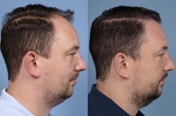 FUE Hair Restoration before and after