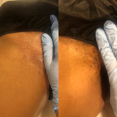 Before and after bikini wax