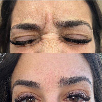 2 weeks post injections in frontalis (forehead), glabella (between eyes) and crows (around the outer eye)

The brow lift