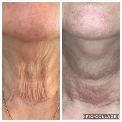 Plasma skin tightening. One session. Will continue to improve! Also good for eyes, mouth, stomach, arms! Innovative and effective treatment.