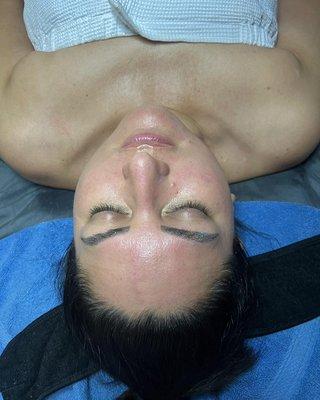 After of a Ultra + Nano fusion facial that targets skin elasticity and sun spot damage on the décolleté.