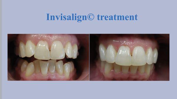 Before and After Invisalign treatment