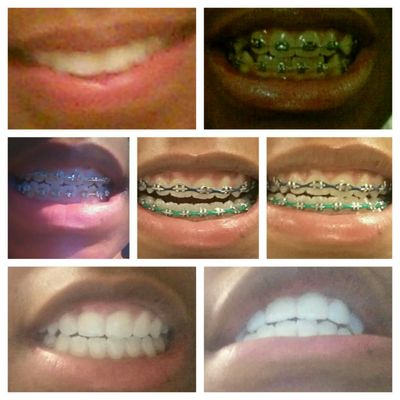 Teeth prior to braces. Teeth after having extractions. Teeth progress to being slanted and misaligned by Dr. Simmons.