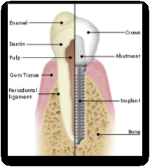 Dental Implant