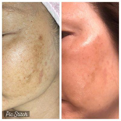 Hyperpigmentation chemical peel facial