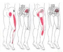 Trigger points can radiate pain down your leg.