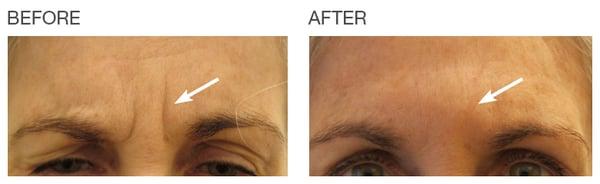 Botox for 11 lines/vertical forehead lines.  Actual patient of Dr. Bracci. Unretouched photo.