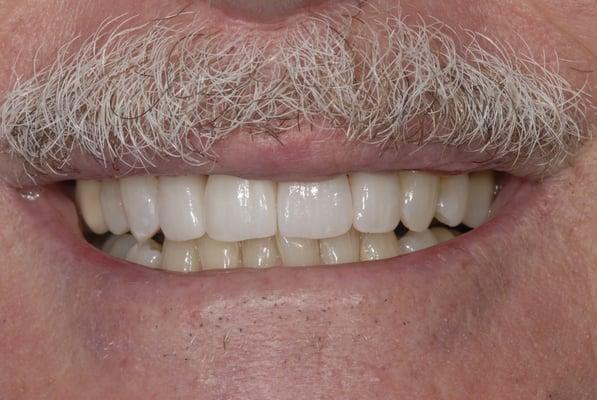 Bill B after, crowns / veneers