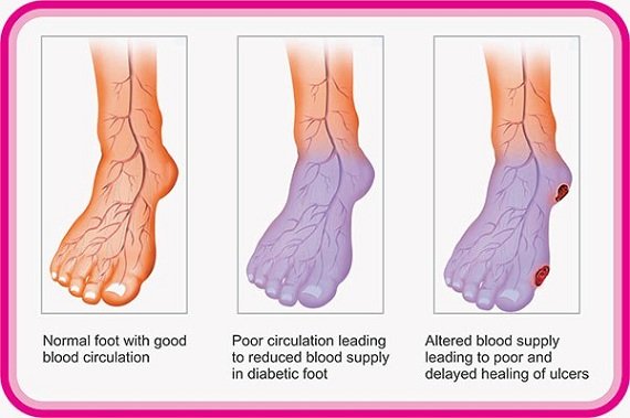 Diabetic foot care