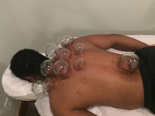 Cupping therapy for neck and shoulder pain.