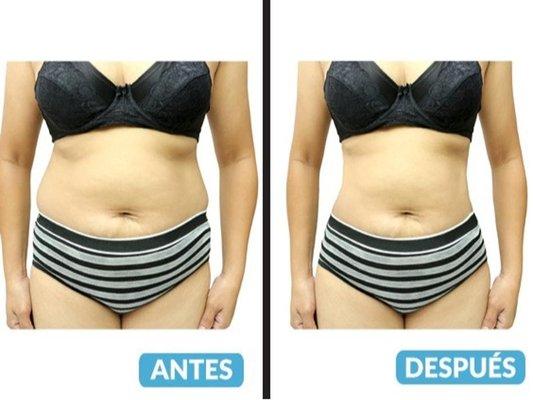 Med-Aesthetic Cosmetic Laser - mujer con antes y despues de tratamiento para descenso de peso