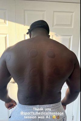 Cupping Therapy