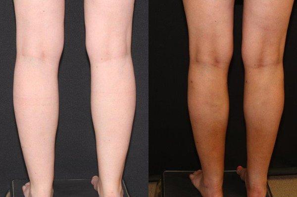 36 year old before and six months after "cankles" liposuction