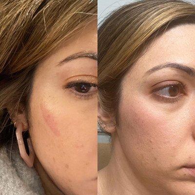 Before/After 
 LED Red Light Treatment reduces scarring.