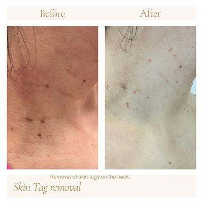 Skin tag removal.