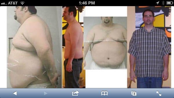 My before and after pics. Dr Gordon is the best!!!