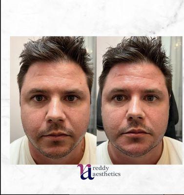 Before and After Radiesse Jaw and Chin filler