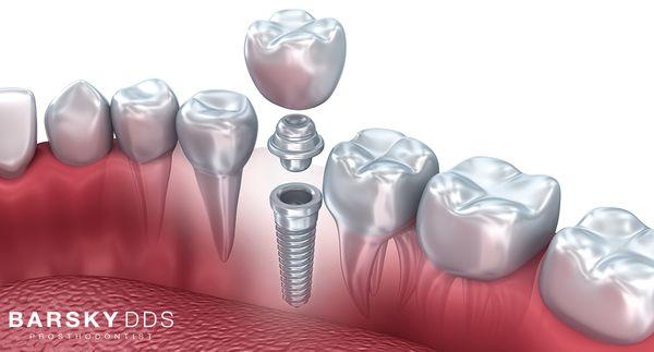 Dental implant at Barsky DDS