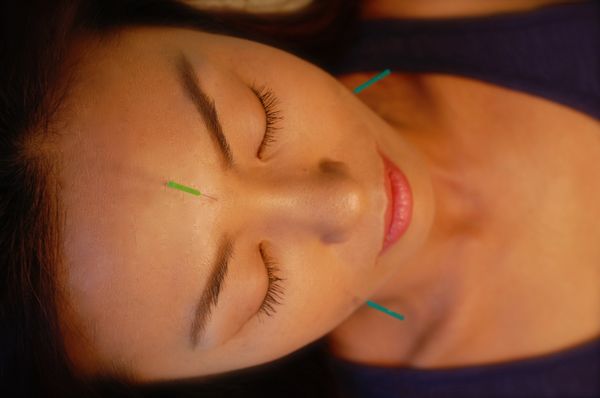 Facial rejuvenation acupuncture enhances beauty by treating the whole body