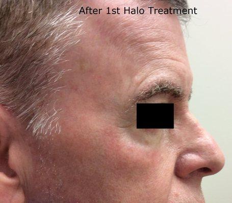 After 1st Halo Treatment