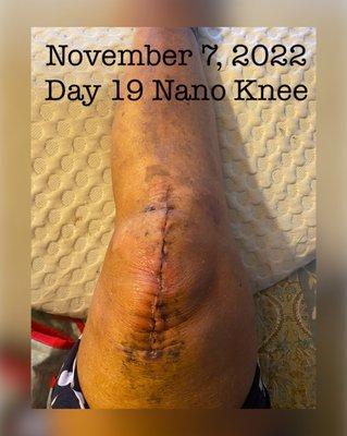 Day 19 after Nano knee full replacement ... incredible bend  120* and 0* straight.  Walk 10 min 3x a day since day 6.