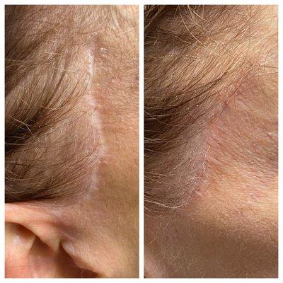 Before & After Face Lift Scar Camouflage