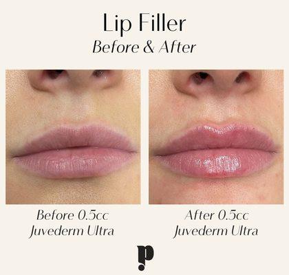 0.5cc of Lip Filler by Alyssa