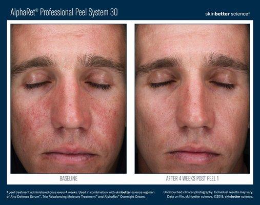 Alpharet Chemical Peel Results