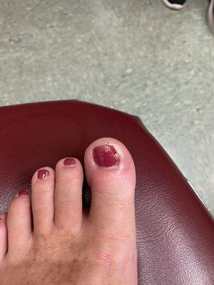 Ingrown toenail