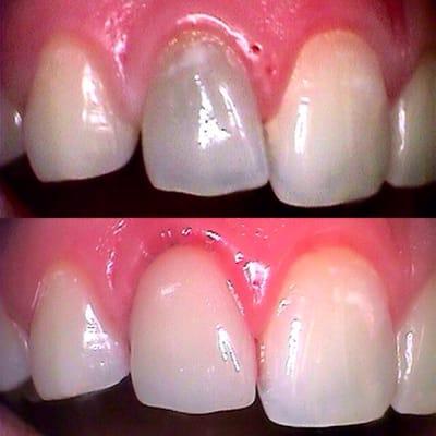 Before & after. "Dead" discolored tooth restored with same day EMax porcelain Cerec crown.  Just in time for the patients wedding photos.