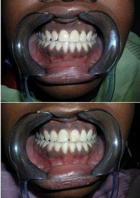 Another happy patient with 2 front veneers