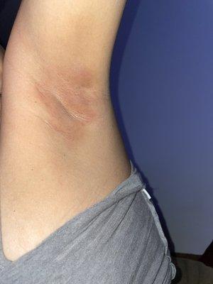 Left armpit was burned with wax the most from excessive waxing and wax temperature.