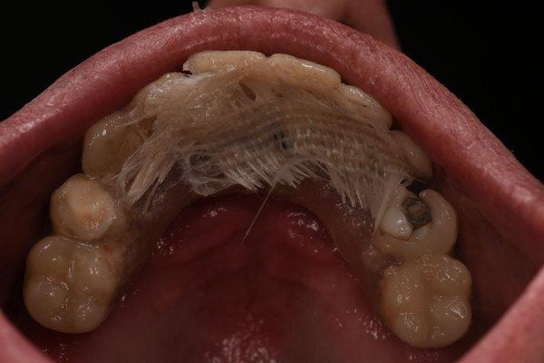 Dr. Lewis' work. I was like this for 4 months. Had to be fixed with superglue & fiberglass to patch my teeth together.