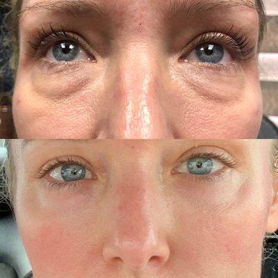 Under eye filler before & after