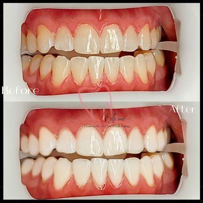 Belle âme Cosmetic Teeth Whitening