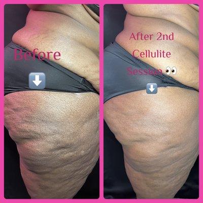 This is her second cellulite session and already seeing results!