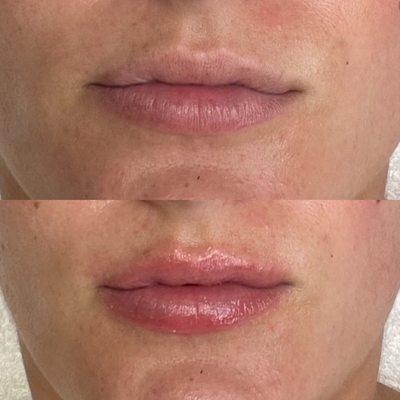 After 1 session of Lip Microneedling! WOW! Usually it's best to have 2-3 sessions a week for continuous results!